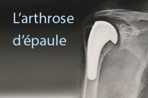 Arthrose de l’épaule