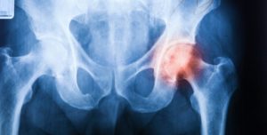 Arthrose de la hanche