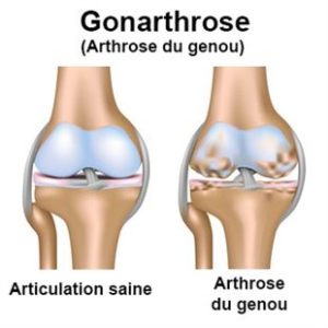 Gonarthrose = arthrose du genou