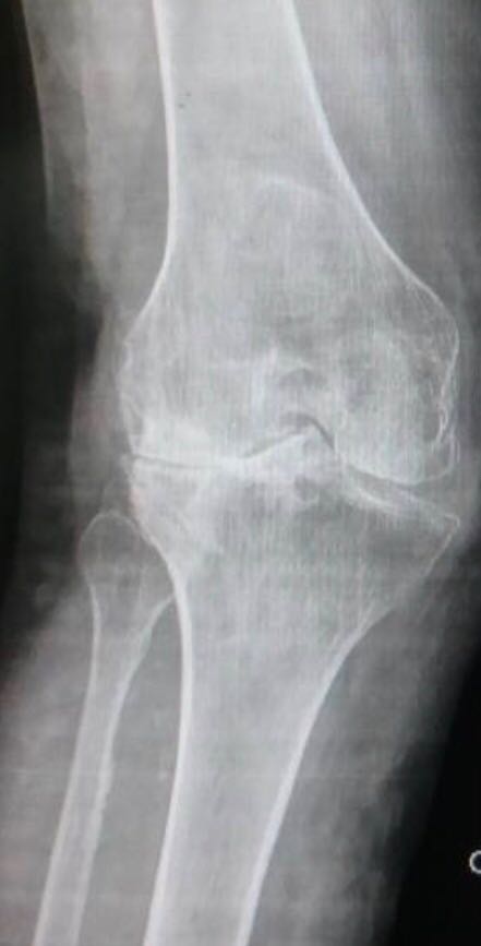 1- Gonarthrose sur Genu valgum