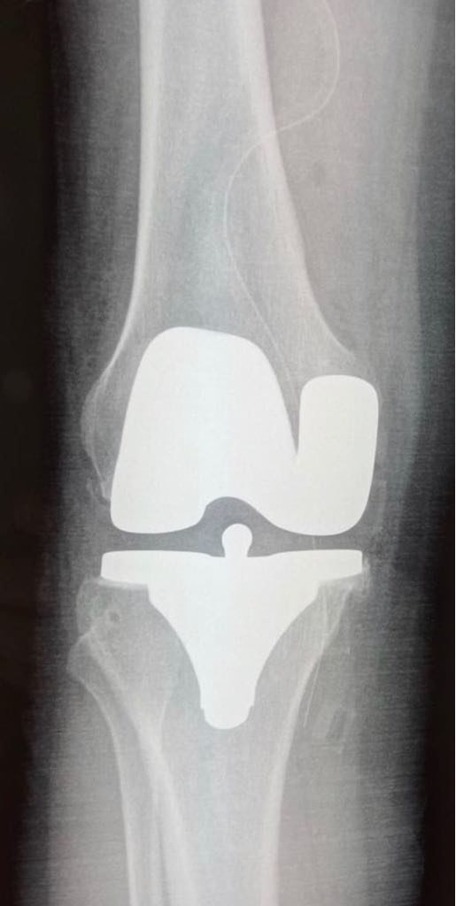 2- PTG postero-stabilisee cimentée