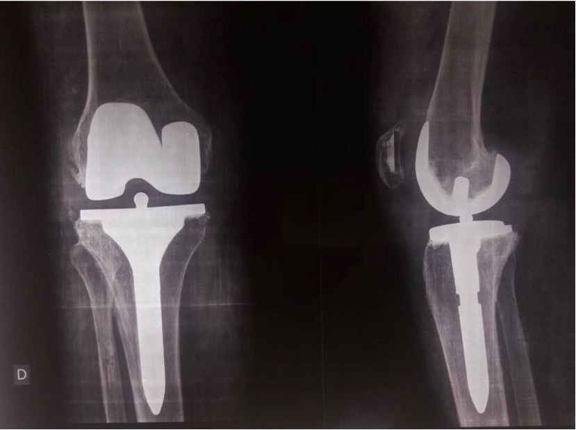 2- PTG postero-stabilisee cimentée avec quille tibiale longue