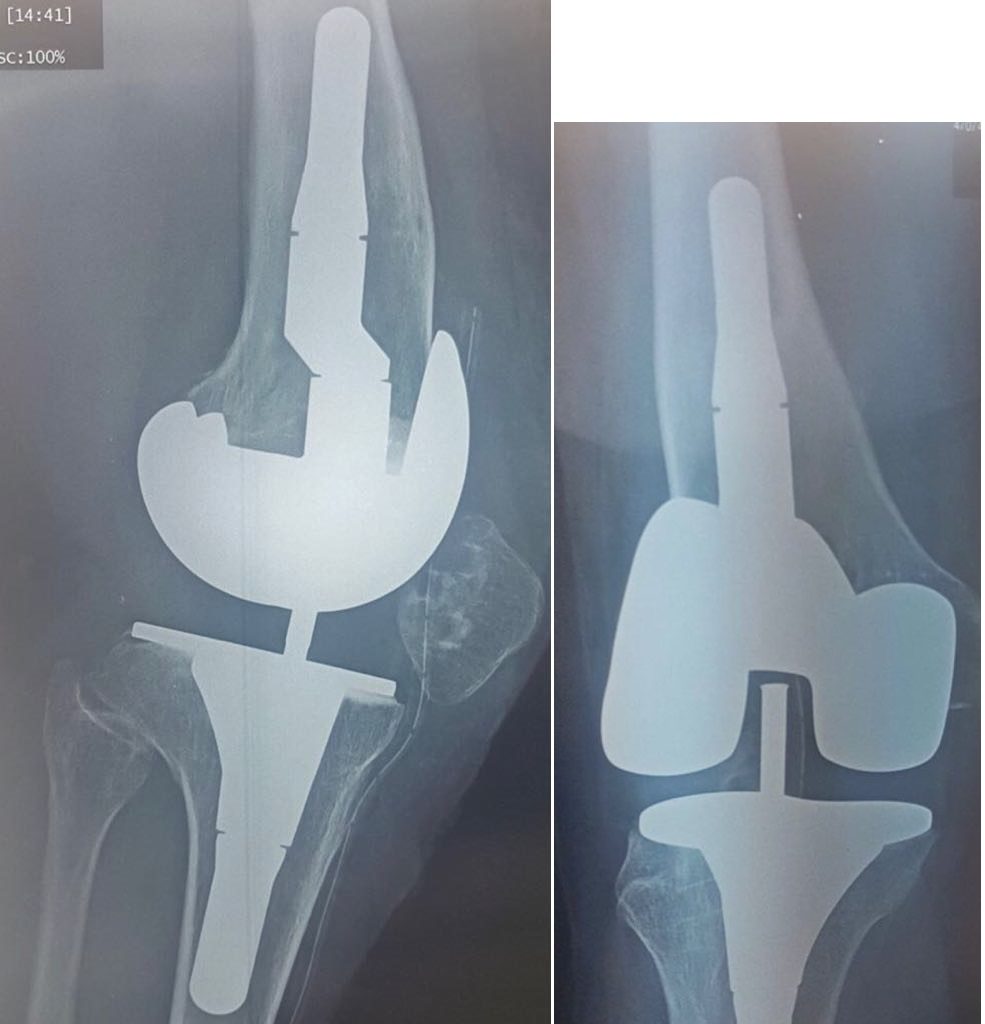 2- edit PTG de reprise cimentée pour une meilleure balance ligamentaire