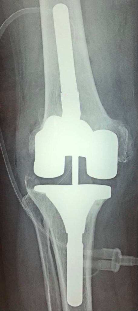 Radio de contrôle de la PTG descellee