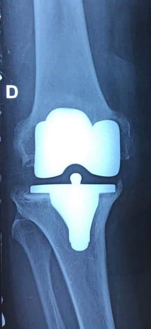 PTG postero-stabilisee cimentée descellée