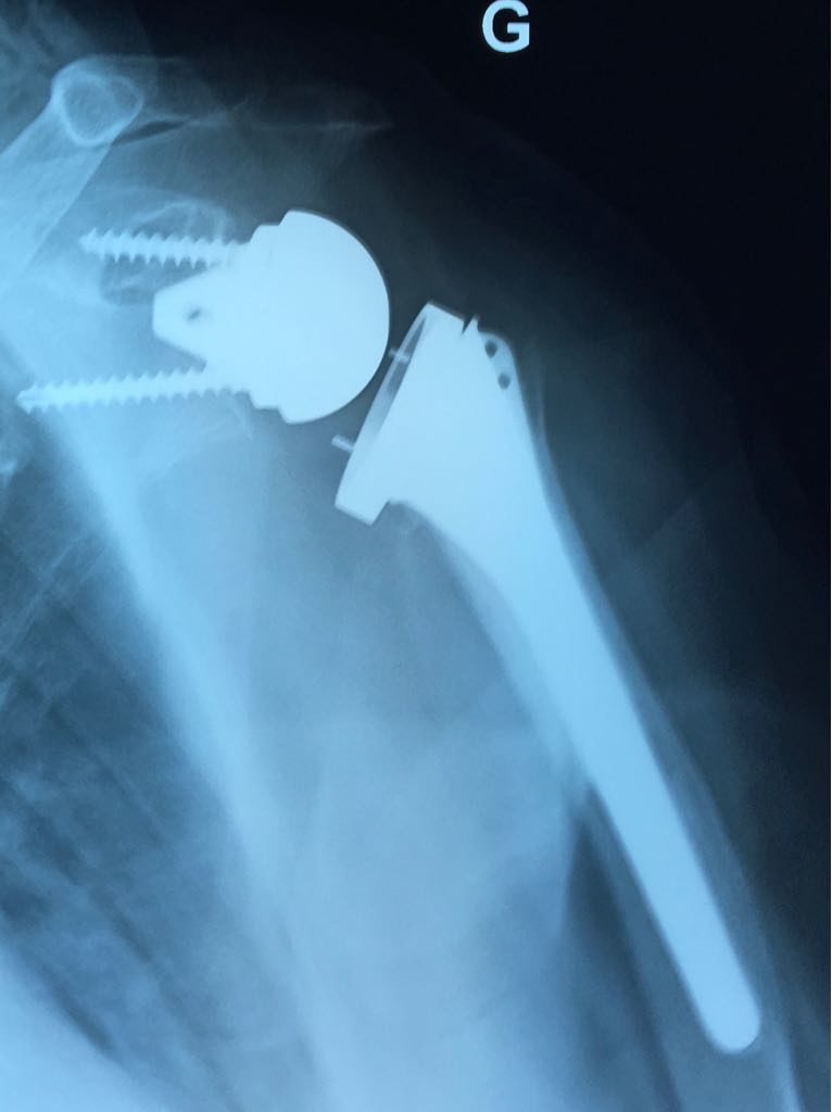 Prothèse totale épaule inversée non cimentée