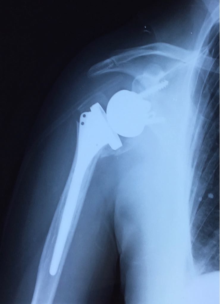 Prothèse épaule inversée avec réinsertion des tubérosités