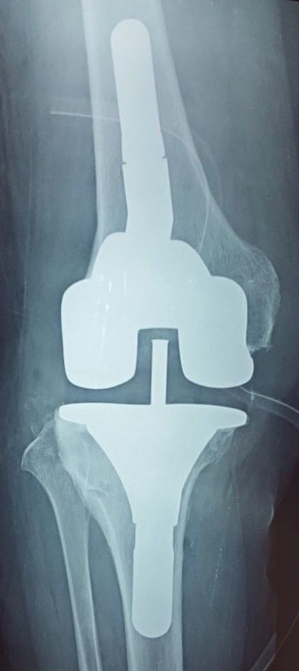 Radio de contrôle de PTG plus contrainte de reprise pour une meilleure stabilité du genou