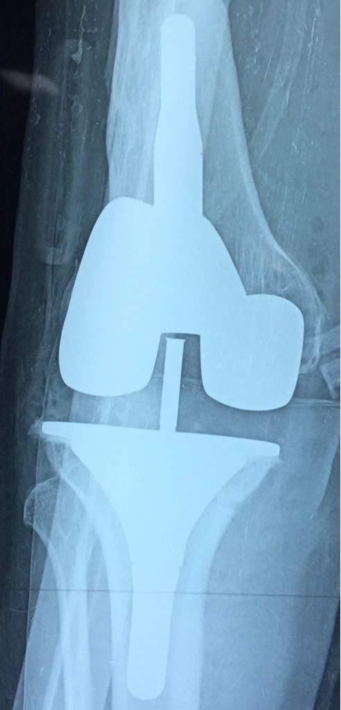 Radio post-Operatoire de PTG de reprise pour une meilleure stabilité du genou